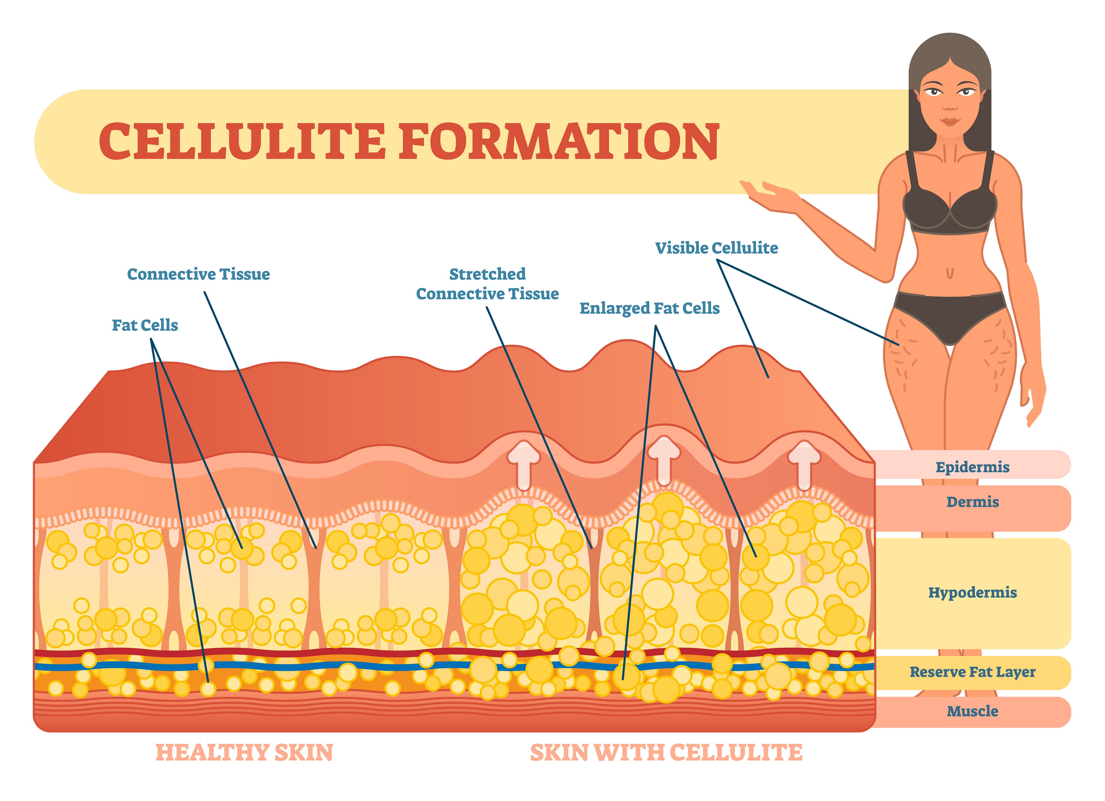 Subcutaneous fat and cellulite